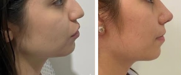Mentoplastia caso 9 — antes y después